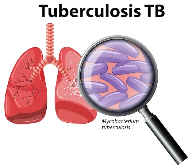 Premium Vector | Human lung with tuberculosis