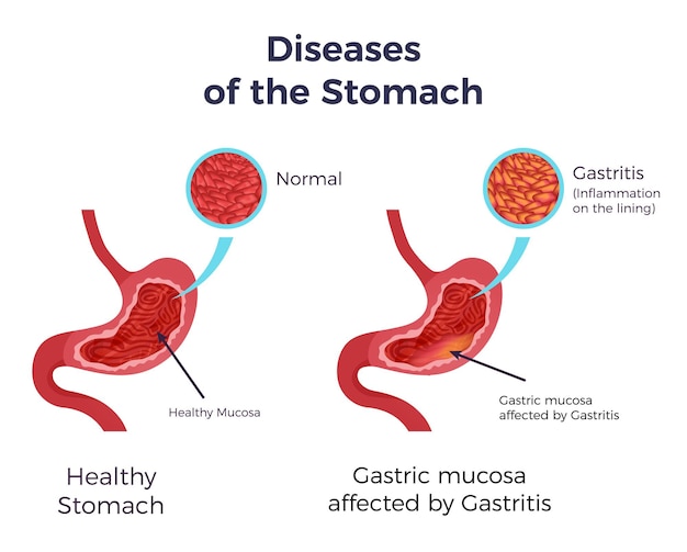 lung-inflammation-symptoms-causes-treatment-more