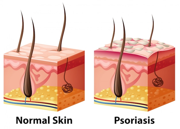 Human skin diagram with normal and psoriasis Premium Vector