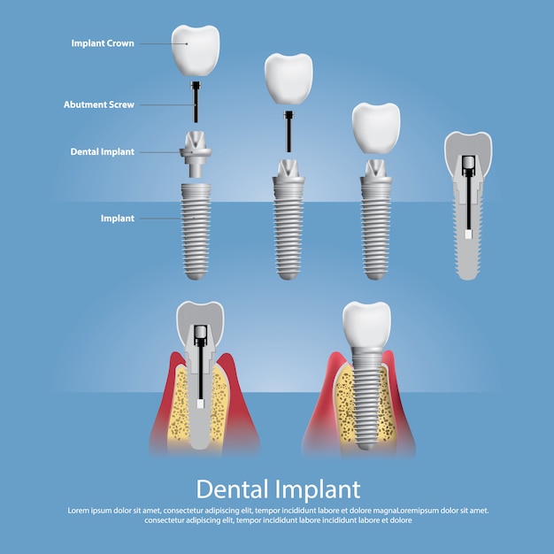 Premium Vector | Human teeth and dental implant illustration