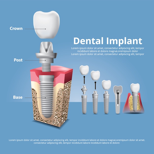 Premium Vector | Human teeth and dental implant illustration