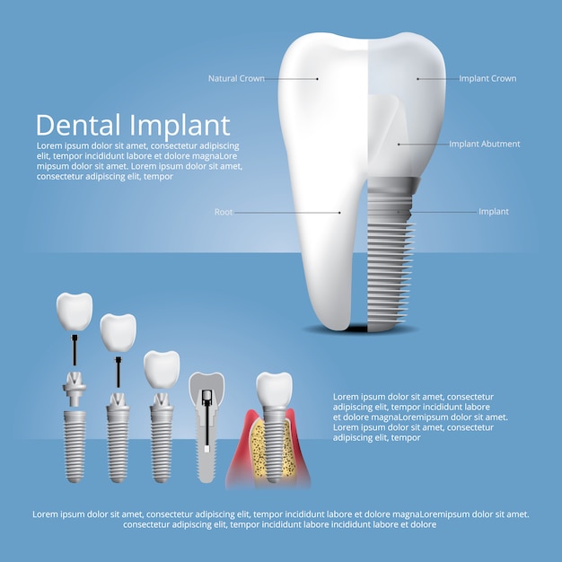 free-vector-human-teeth-and-dental-implant-template