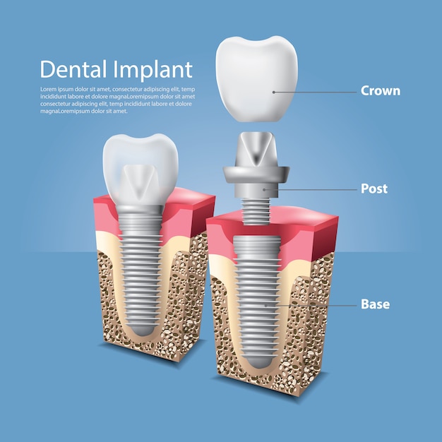 Premium Vector Human Teeth And Dental Implant Vector Illustration