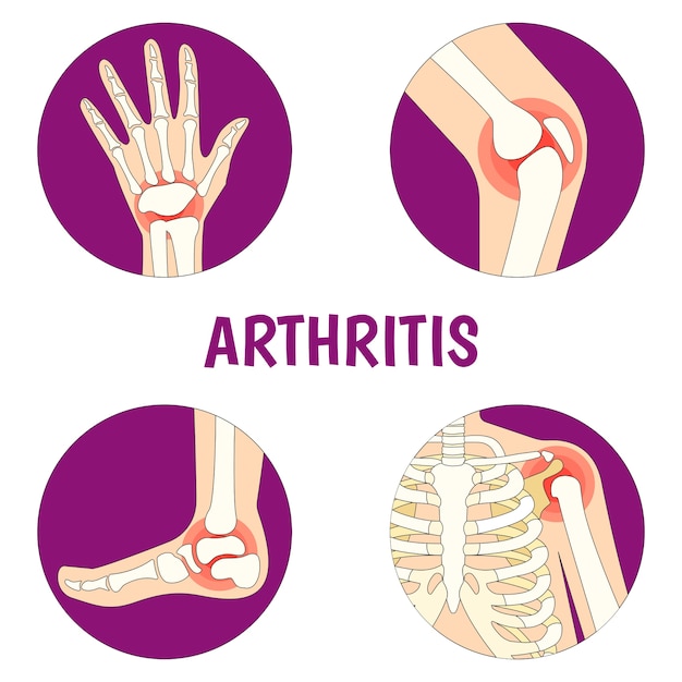 Premium Vector Illustration About Arthritis 1115