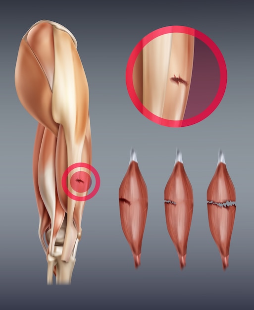 脚の筋肉の損傷のイラスト プレミアムベクター