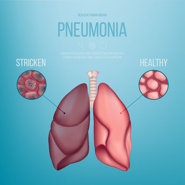 健康な肺と肺炎の影響を受けた肺の画像 リアルなイラスト プレミアムベクター