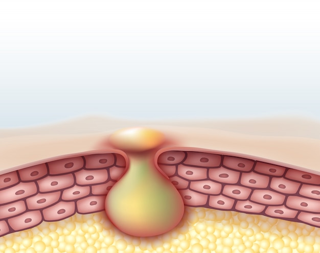 Premium Vector | Inflammatory acne