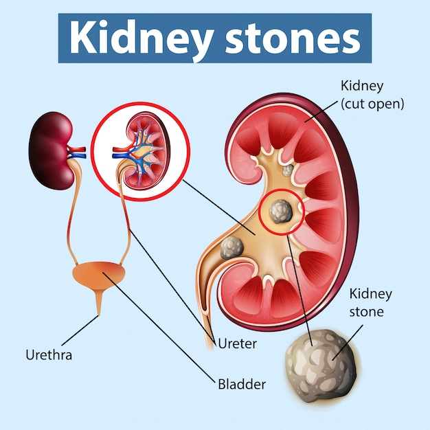 free-vector-informative-illustration-of-kidney-stones