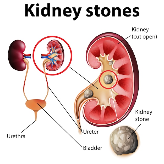 Free Vector | Informative illustration of kidney stones