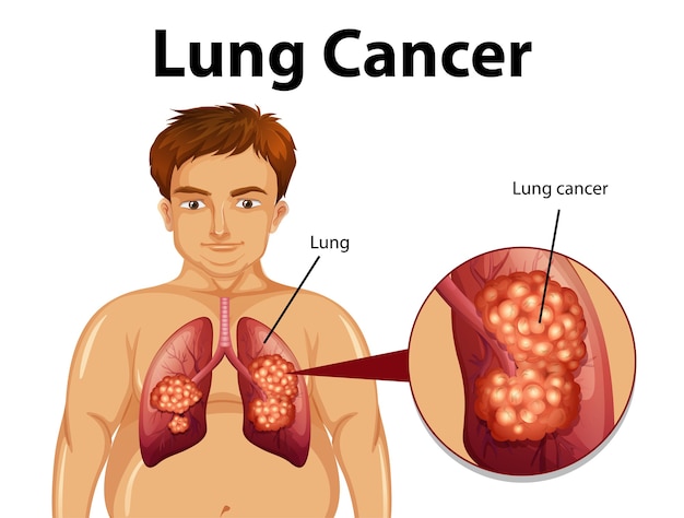 Download Free Vector | Informative illustration of lung cancer