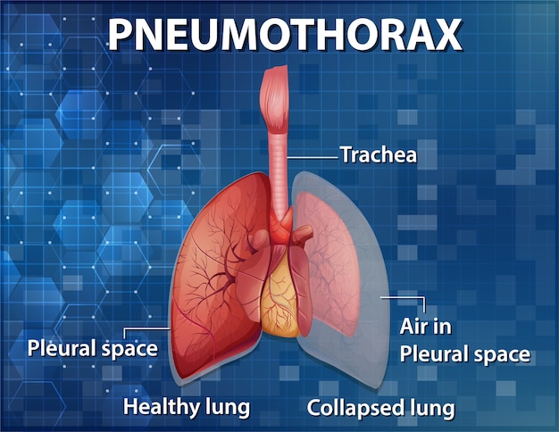 Free Vector | Informative illustration of pneumothorax