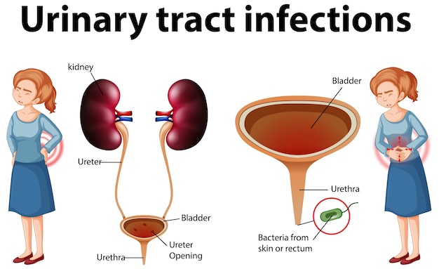 Free Vector Informative Illustration Of Urinary Tract Infections 7994