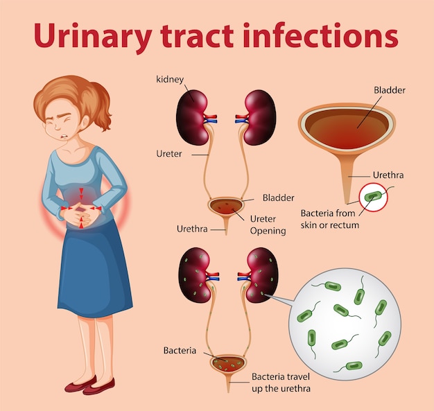 Premium Vector Informative illustration of urinary tract infections