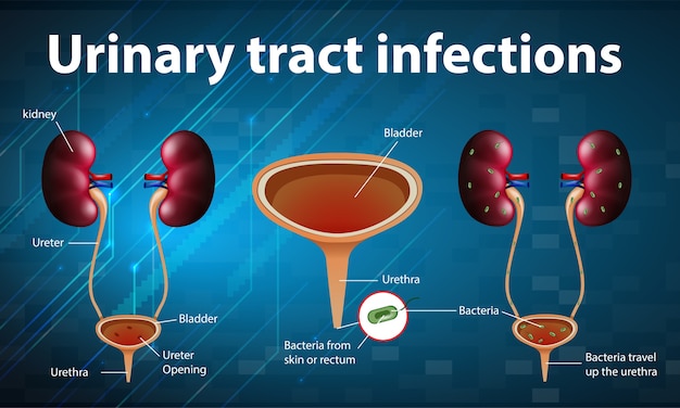 Free Vector Informative Illustration Of Urinary Tract Infections