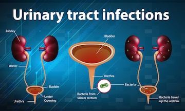 Free Vector | Informative illustration of urinary tract infections