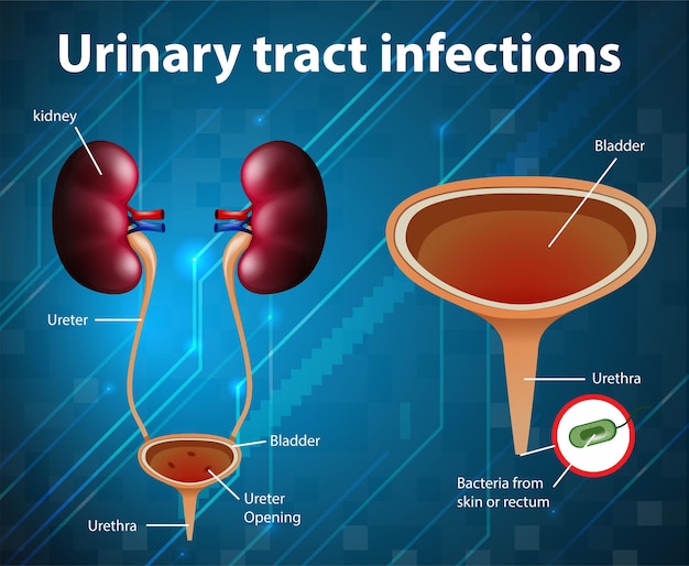 Free Vector | Informative Illustration Of Urinary Tract Infections