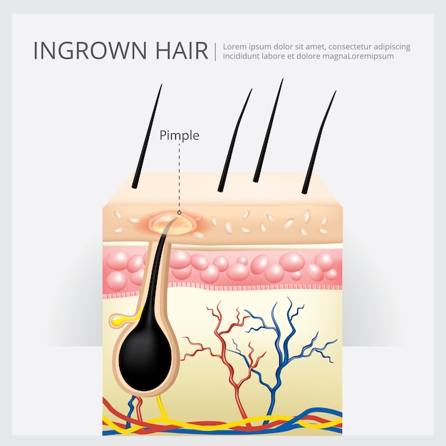 Ingrown Hair Structure Premium Vector