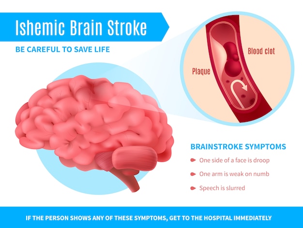 presentation of ischaemic stroke