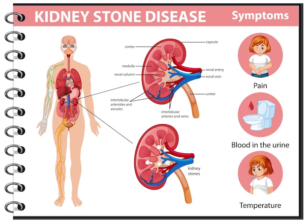 Free Vector | Kidney stones disease and symptoms infographic