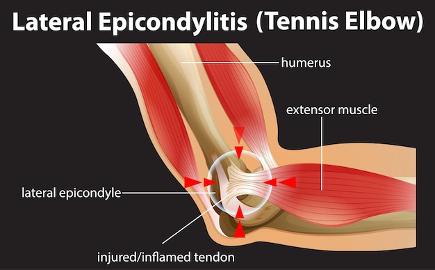 Anatomical structures of a tennis elbow or lateral epicondylitis