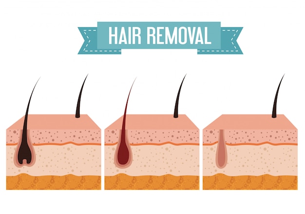 Layers skin structure with hair removal elements Free Vector