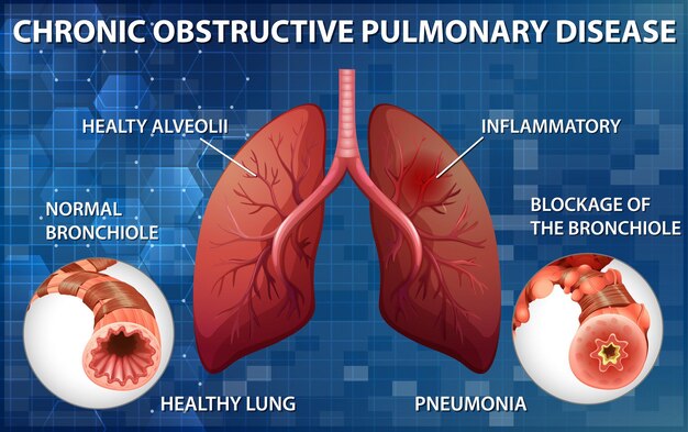 Free Vector | Lung with chronic obstructive pulmonary disease