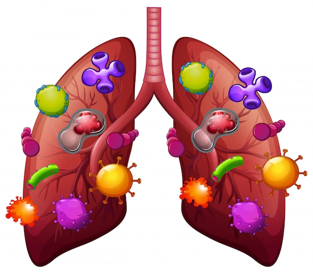 Premium Vector | Lungs covered with bacteria illustartion