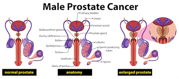 Premium Vector Male Prostate Cancer Diagram