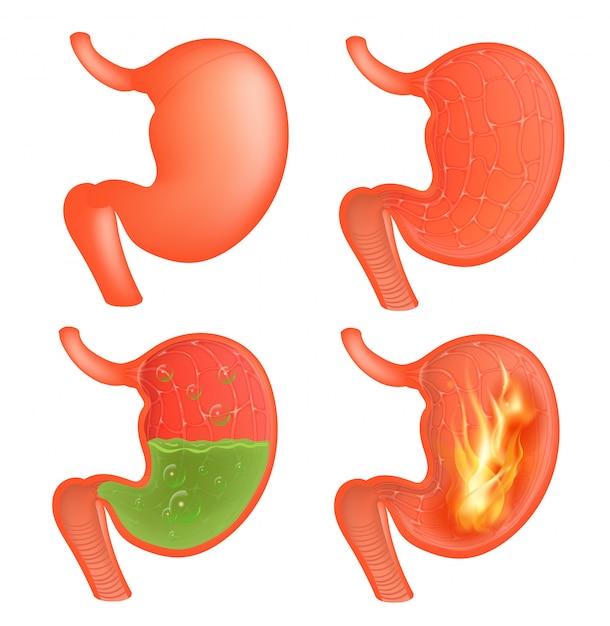 Premium Vector Medical Illustration Of Realistic Stomach Outside And Inside Gastritis And Acid Reflux Indigestion And Stomach Pain Problems