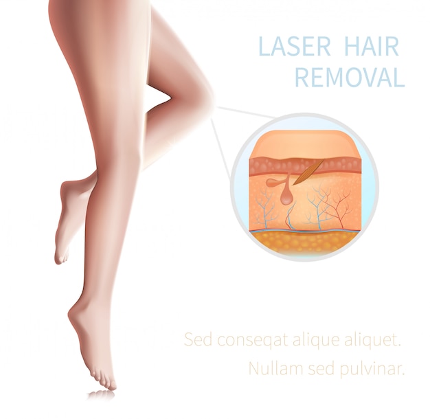 laser hair removal procedure