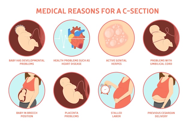 premium-vector-medical-reasons-for-cesarean-delivery-or-c-section