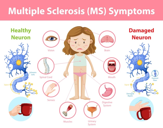Free Vector | Multiple sclerosis (ms) symptoms information infographic