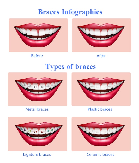 How Expensive Are Braces In Australia