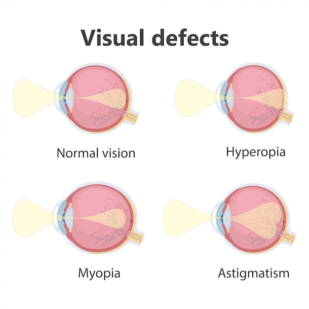 Premium Vector | Ophthalmic poster, eye defects.