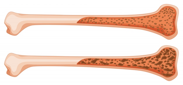 Osteoporosis in human bone Free Vector