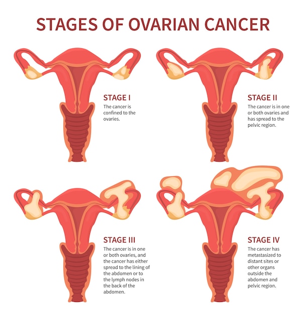 Premium Vector Ovarian cancer four stages mentioning ovaries