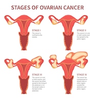 Premium Vector Ovarian Cancer Four Stages Mentioning Ovaries