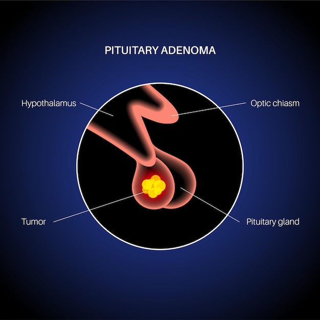 Premium Vector Pituitary Adenoma Concept Tumor In The Human Brain Disease Or Cancer In The 7276