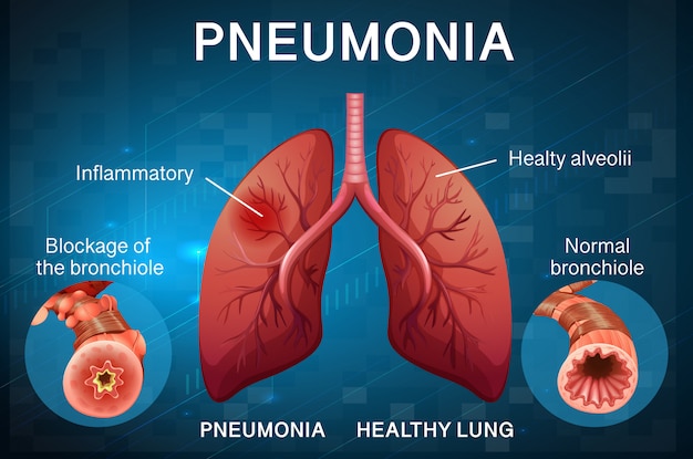 Poster design for pneumonia with human lungs | Free Vector