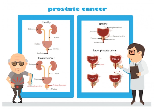 Prostate cancer illustration Vector | Premium Download