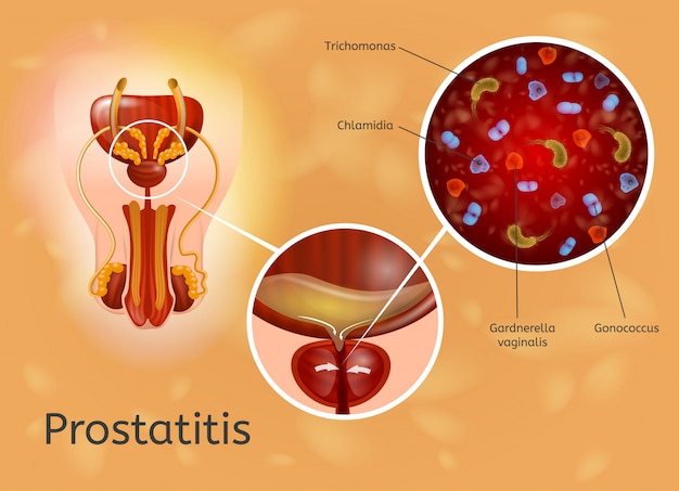 Prostatitis anatómia Ha a prosztata vizelet vérrel