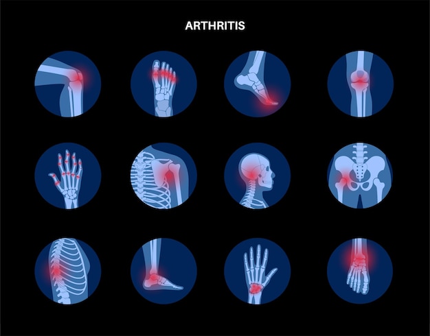  Rheumatoid arthritis, pain, bone disease concept. Premium Vector