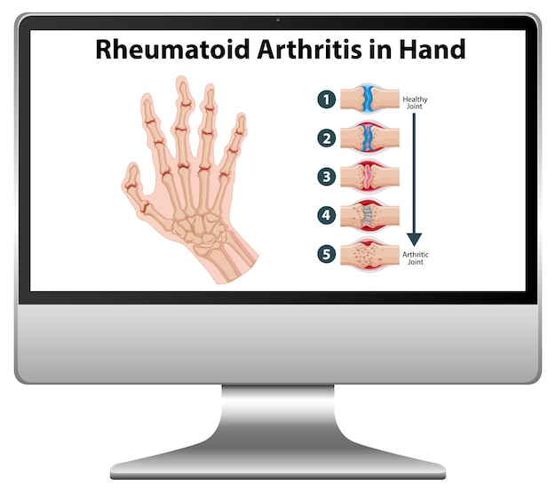 Rheumatoid arthritis symptoms on hand on computer desktop Free Vector