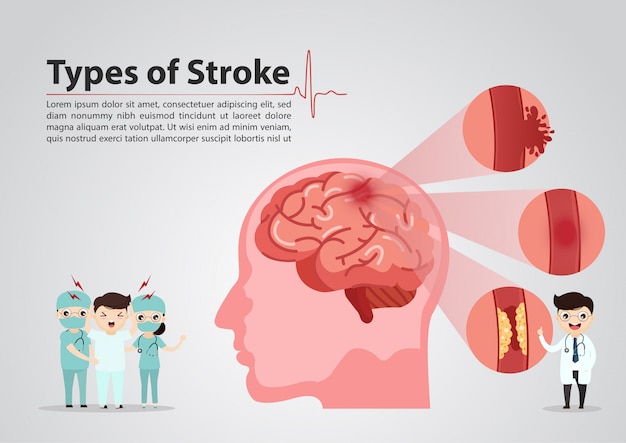 Scientific Medical Of Human Brain Stroke Illustration Vector Premium Download