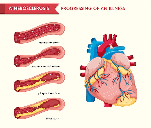 Scientific medical illustration of atherosclerosis Vector | Free Download