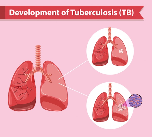 Free Vector Scientific medical infographic of tuberculosis