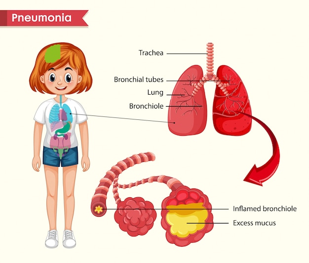 Scientific medical, pneumonia concept Premium Vector