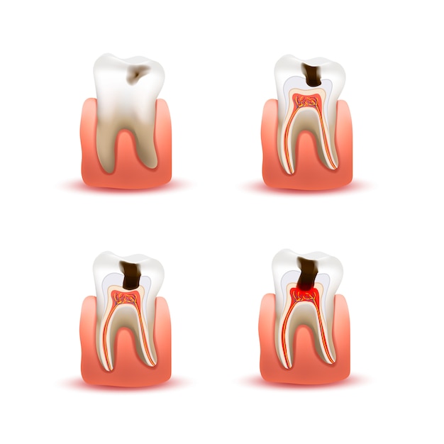 4つの異なる虫歯の段階で人間の歯のセット 白のインフォグラフィックグラフ プレミアムベクター