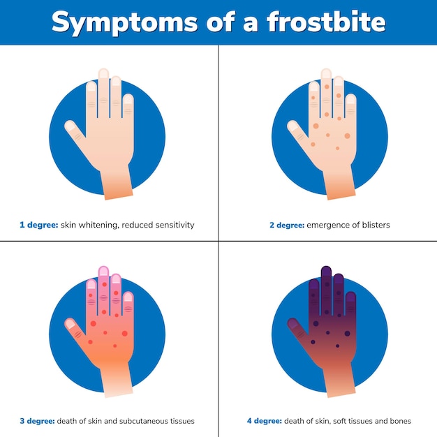 Premium Vector | Simptoms of a frostbite. 4 medical stages. infographic ...