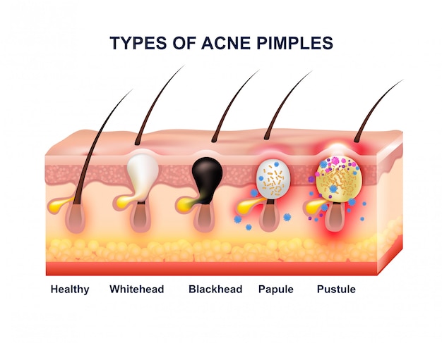 Free Vector | Skin acne anatomy composition